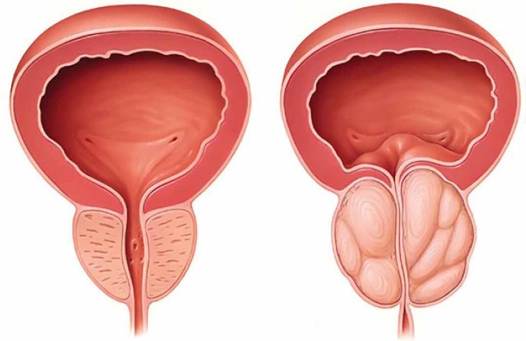 Normale Prostata und Prostataentzündung (chronische Prostatitis)