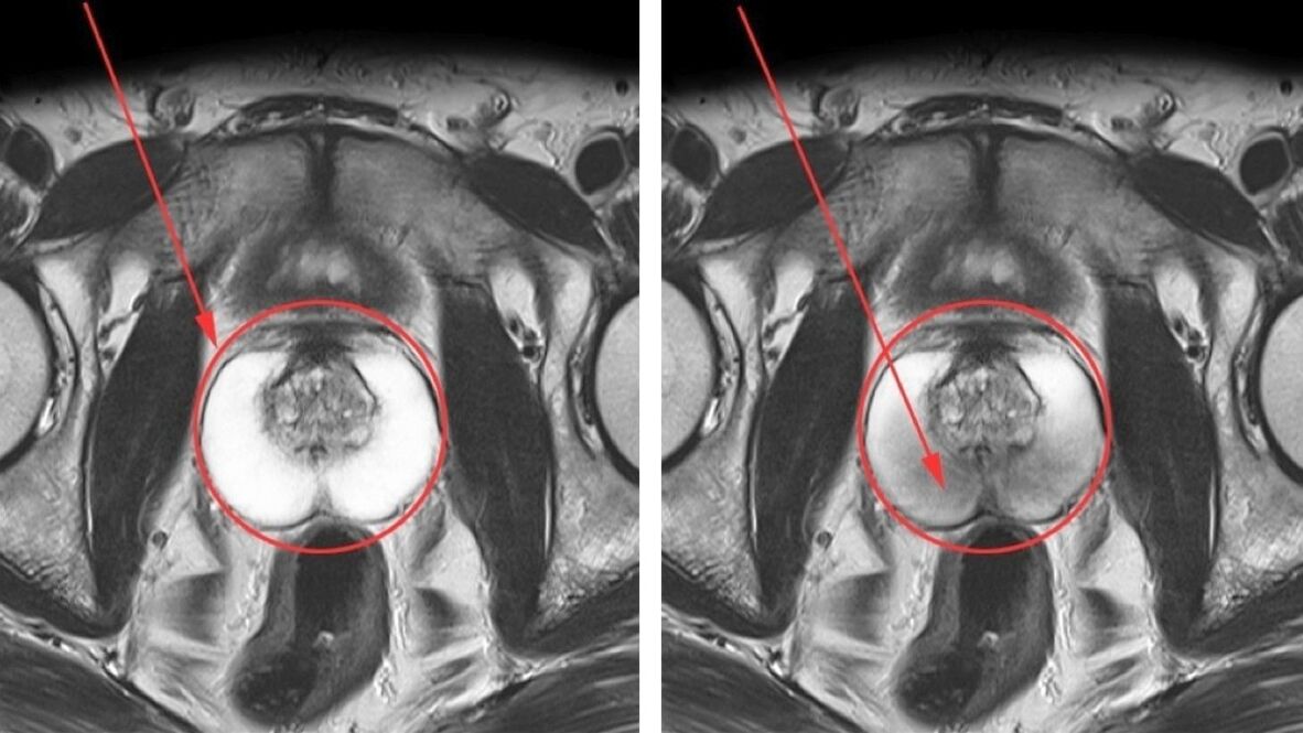 Ultraschall bei chronischer Prostatitis, gesunder (links) und entzündeter (rechts) Prostata