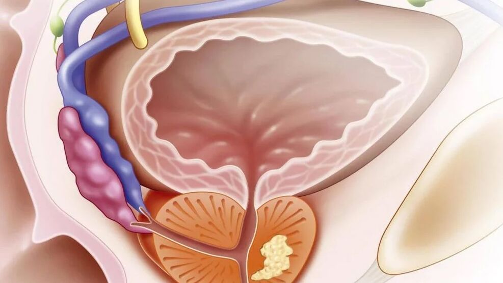 Chronische nebakterielle Prostatitis