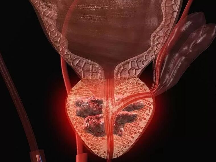 Prostatitis bei Männern