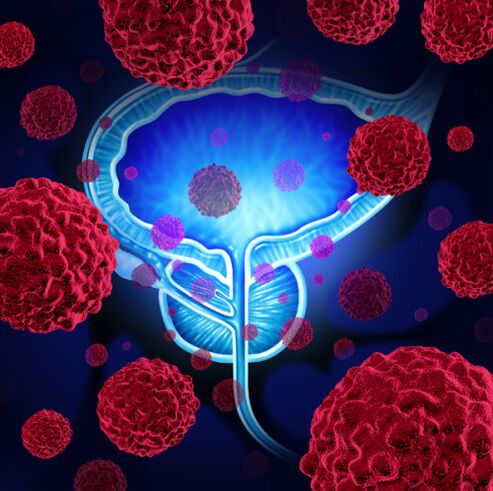 Die Aktivität pathogener Mikroorganismen ist die Ursache für die Entstehung einer Prostatitis.