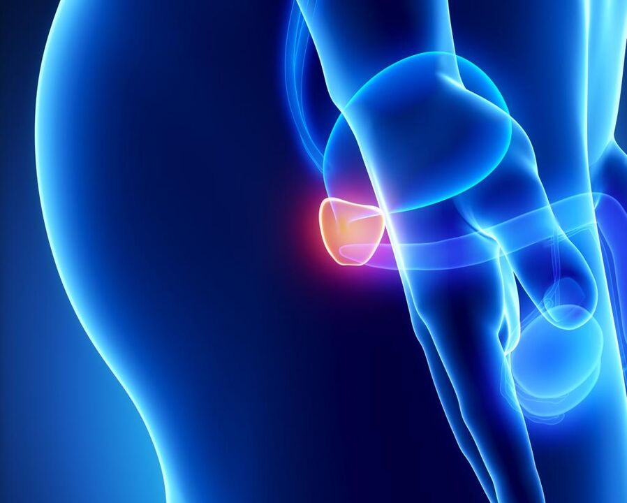 Entzündung der Prostata.