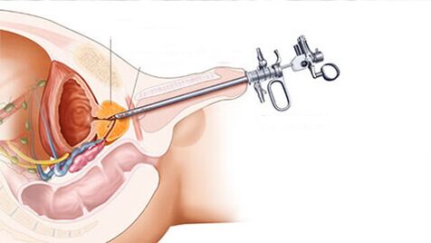Chirurgische Behandlung von Prostatitis