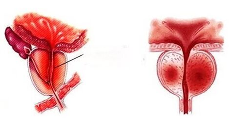 Wie sehen Sie chronische Prostatitis